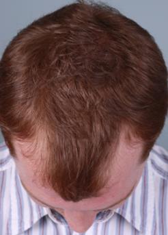 Before Hair Transplant&nbsp;Hairlines